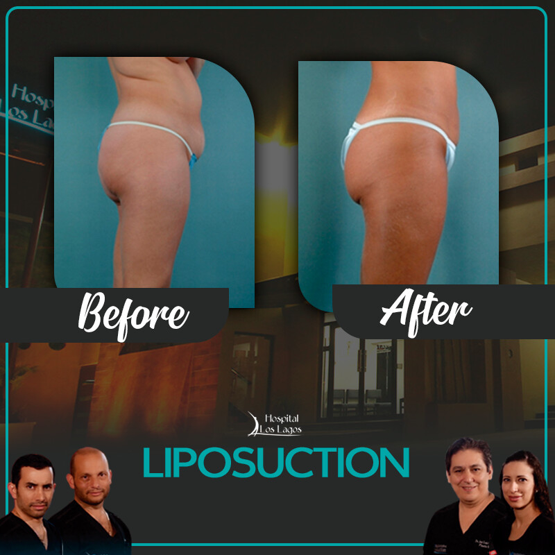 Before and After Result